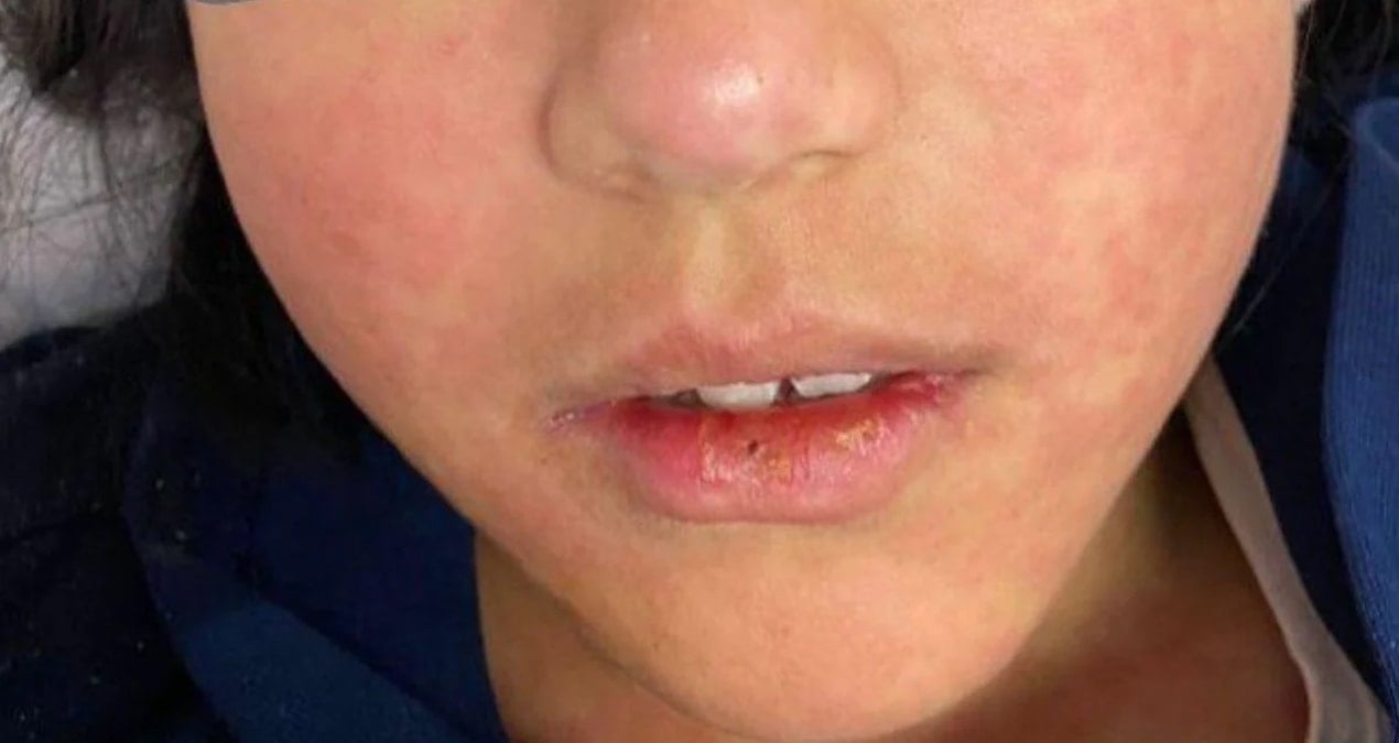 Bangladeş’te Kızamık Salgını: 6 Haftada 227 Çocuk Hayatını Kaybetti